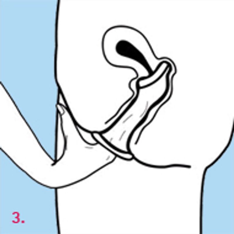 Illustration of how to use female condoms for contraception with proper placement steps.