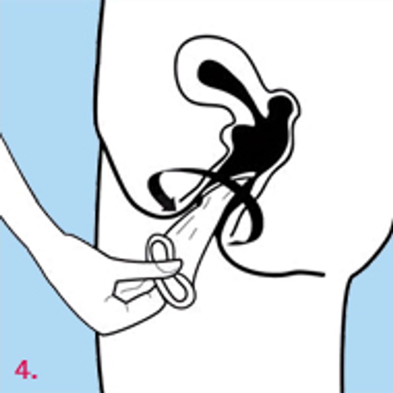 How to use Femidom female condoms for contraception effectively demonstrating insertion.